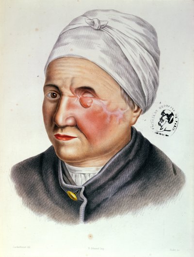 Illustration from Traite de Chirurgie Plastique by Antoine Jobert de Lamballe (1799-1867) Paris, 1849 by Lackerbauer